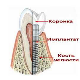 Как проводится имплантация зубов