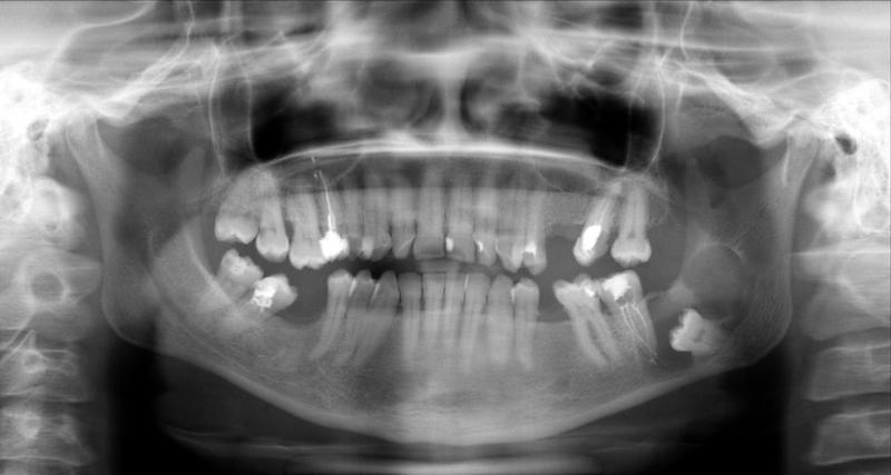 Ортопантонограмма кисты зуба