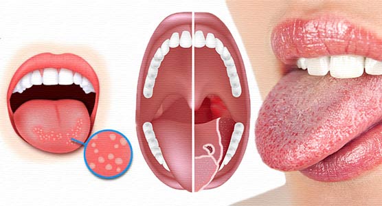 Все причины воспаления языка и виды глосситов