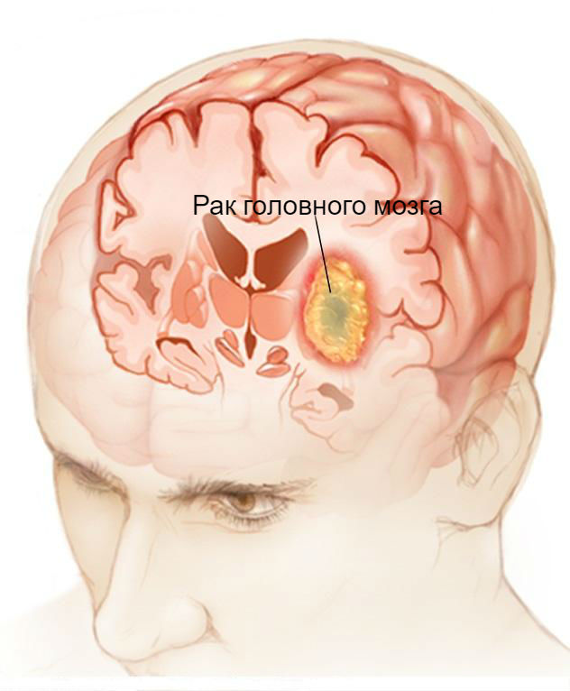 Ранние симптомы рака головного мозга