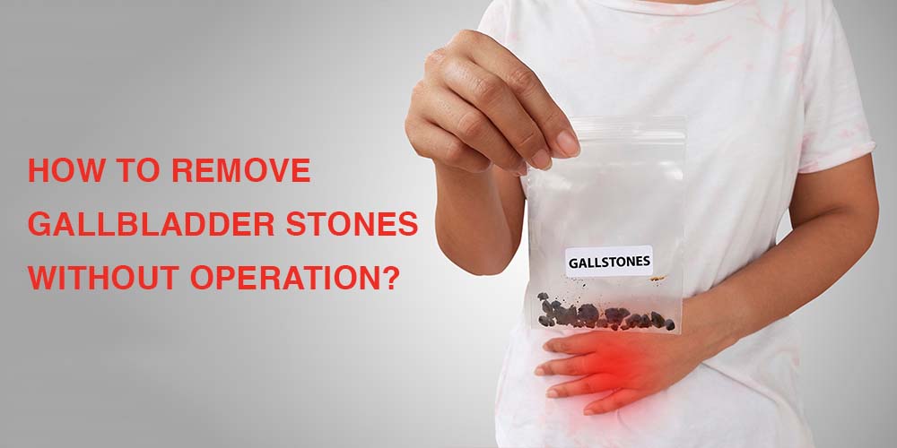 Remove gallstones without operation