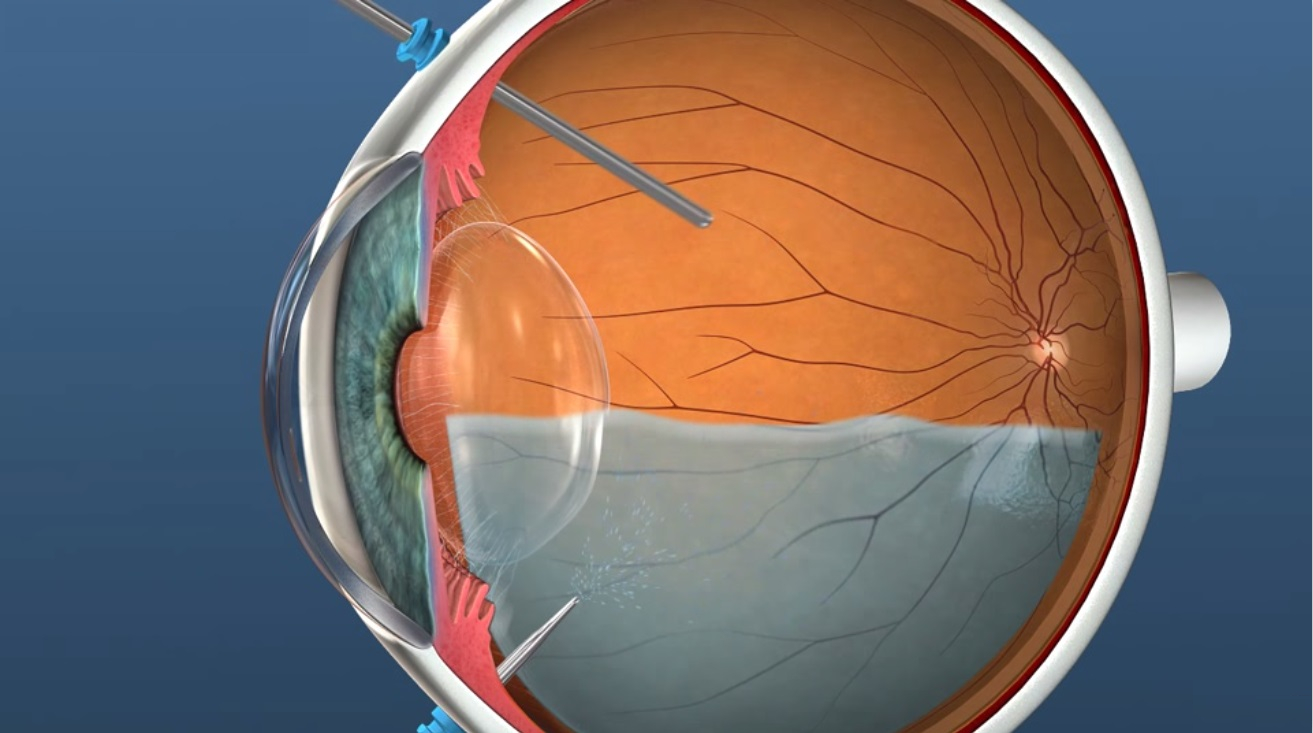 Вылечит ли близорукость операция. Отслойка сетчатки витрэктомия. Регматогенная отслойка сетчатки. Отслойка сетчатки катаракта. Витрэктомия ретинопатия.