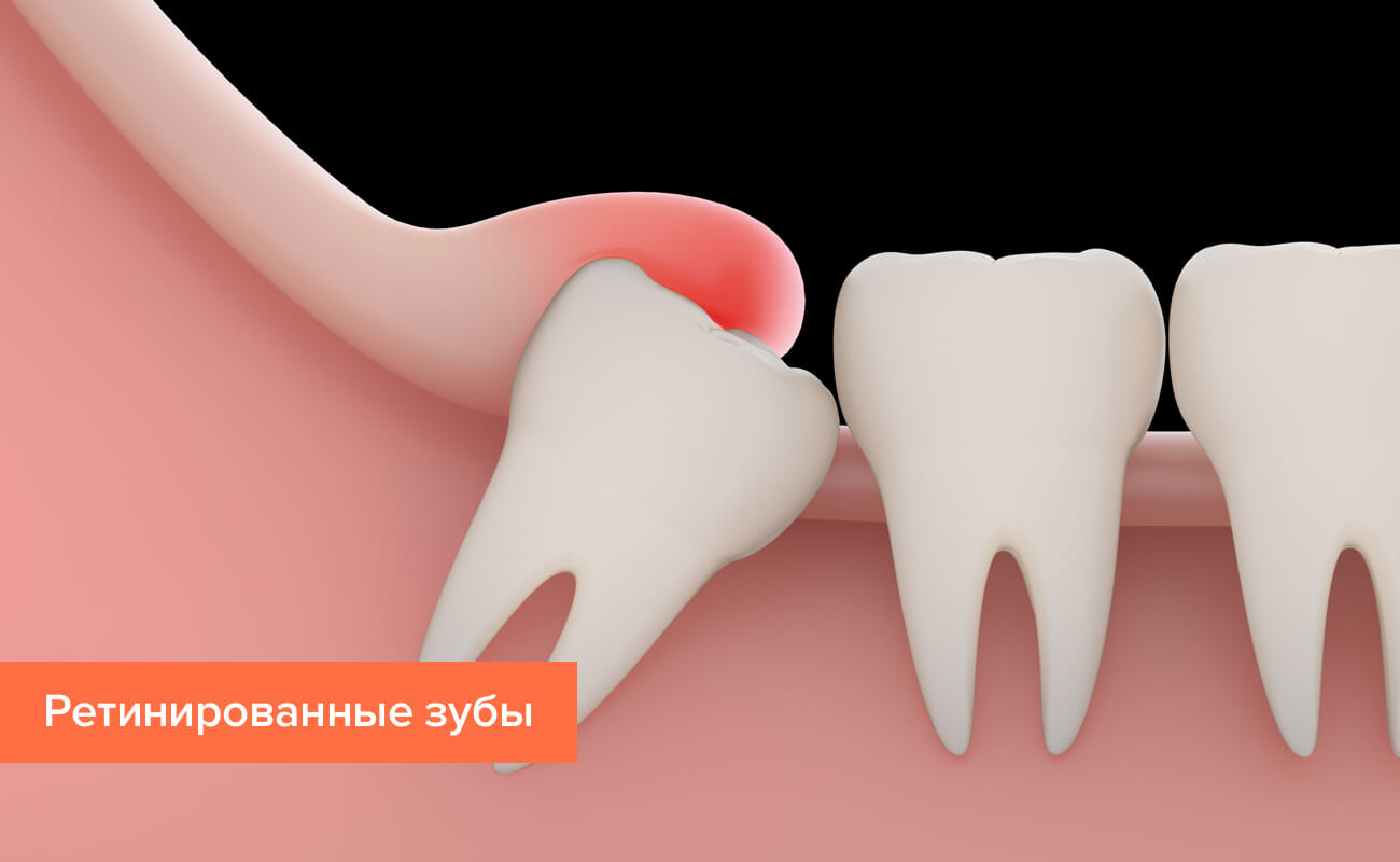 Ретинированные зубы в картинках