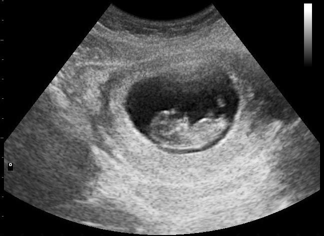 температура в первом триместре беременности