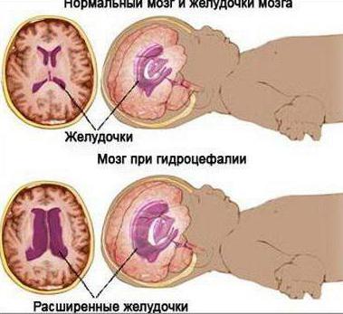 лечение гидроцефалии мозга