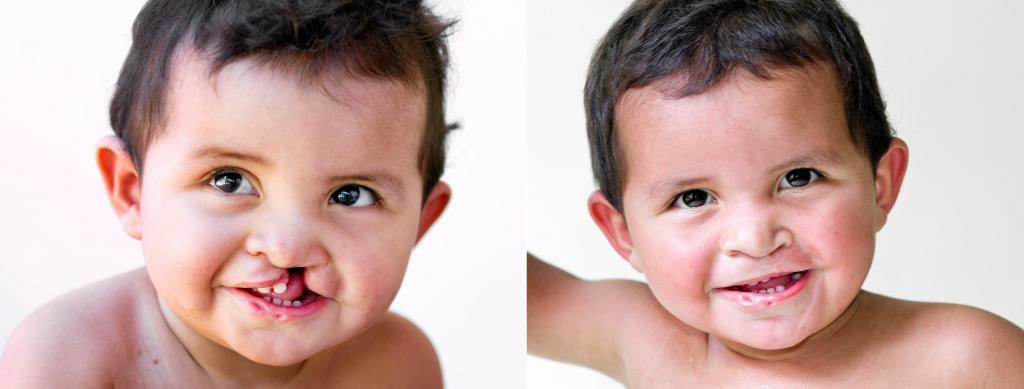 фото до и после операции