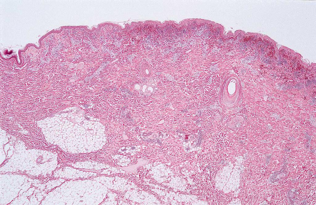 болезнь рожа под микроскопом