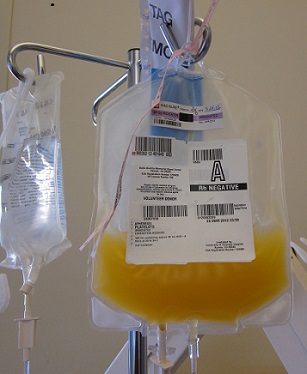 thrombocytopenia treatment platelet transfusion