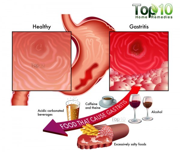 gastritis diagram