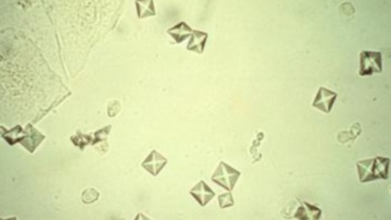 Кристаллы оксалата в моче у мужчин. Оксалаты кальция в моче под микроскопом. Кристаллы оксалата кальция в моче. Кристаллы оксалата кальция микроскопия. Оксалаты кальция в моче микроскопия.