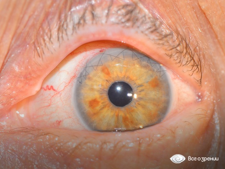 резкая глазная боль после операции
