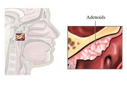Аденоидный вегетация 3. Глоточная миндалина аденоиды. Анатомия носоглотки аденоиды. Аденоидные вегетации клиника.