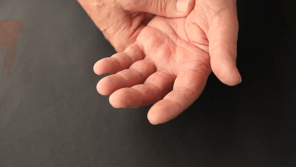 Тремор рук: причины, лечение