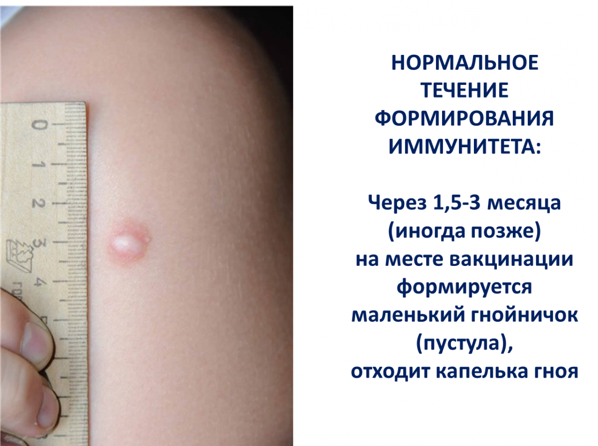 Прививка БЦЖ норма реакции. БЦЖ прививка реакция ребенка 2 года. Прививка БЦЖ период заживления.