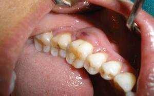 Абсцесс зуба  - лечение у стоматолога