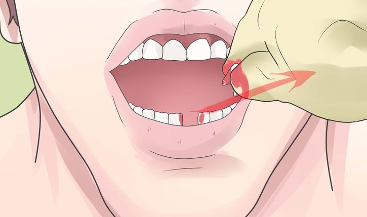 Как без боли вырвать зуб в домашних условиях