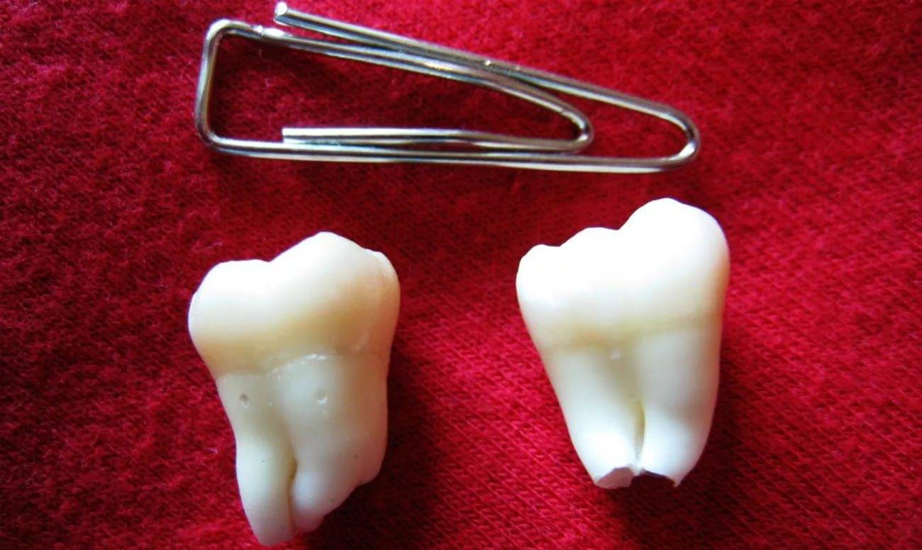 коренные зубы