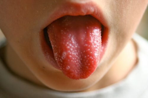 Аллергическое опухание языка