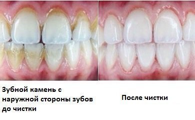 До и после чистки камня у стоматолога