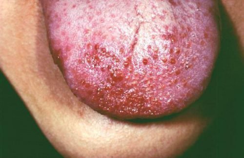 Прыщи на языке при аллергии
