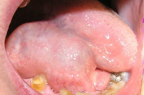 Опухоль слюнной железы под языком