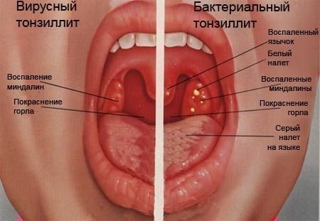 Виды тонзилита в горле