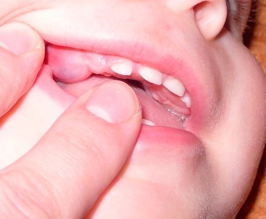 Десна при прорезывании зубов