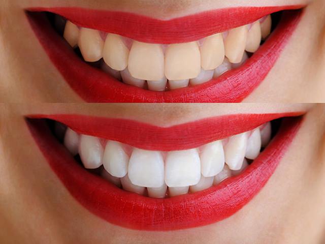 Разница между обычными зубами и зубами, которые отбелили